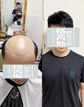 男生增發(fā)可以試試物理增發(fā)織發(fā)補(bǔ)發(fā)產(chǎn)品，這種可以快速增加發(fā)量，達(dá)到密發(fā)效果