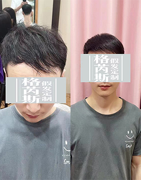 定制補(bǔ)發(fā)及以后日常大力是必不可少的，良好的使用習(xí)慣讓假發(fā)更好看