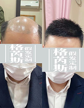 到店測(cè)量頭型，根據(jù)脫發(fā)面積大小進(jìn)行測(cè)量，獲取補(bǔ)發(fā)重要數(shù)據(jù)