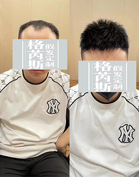 測(cè)量后，與客戶(hù)溝通需要定制的樣式造型和發(fā)長(zhǎng)制定，確定補(bǔ)發(fā)方案